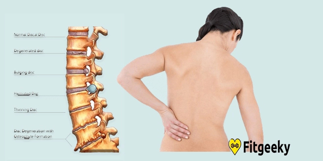 common causes of back pain